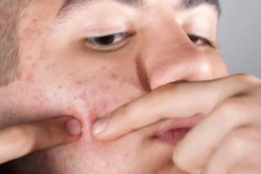S buz002943 03 picking at pimples cuts scrapes or insect bites