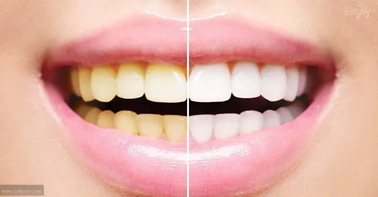 8 Façons Naturelles de Blanchir Vos Dents.