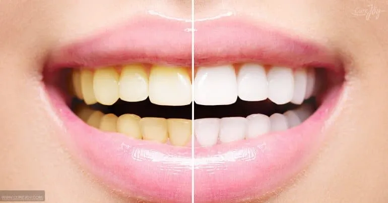 blanchir les dents