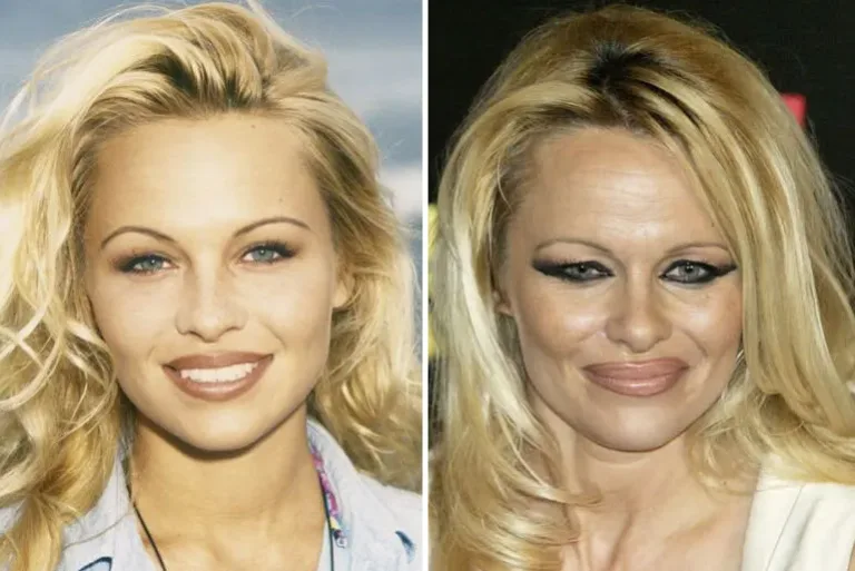 20 celebrites au physique ravage par la chirurgie esthetique