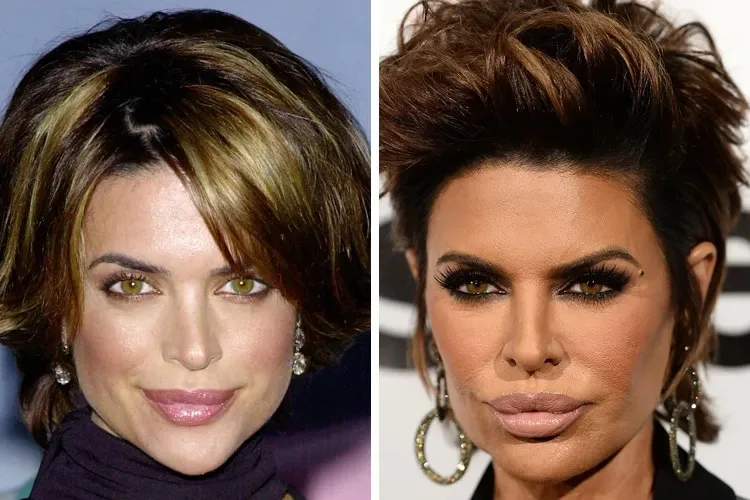 20 celebrites au physique ravage par la chirurgie esthetique