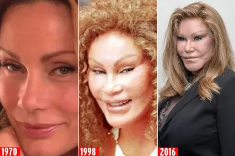 20 celebrites au physique ravage par la chirurgie esthetique